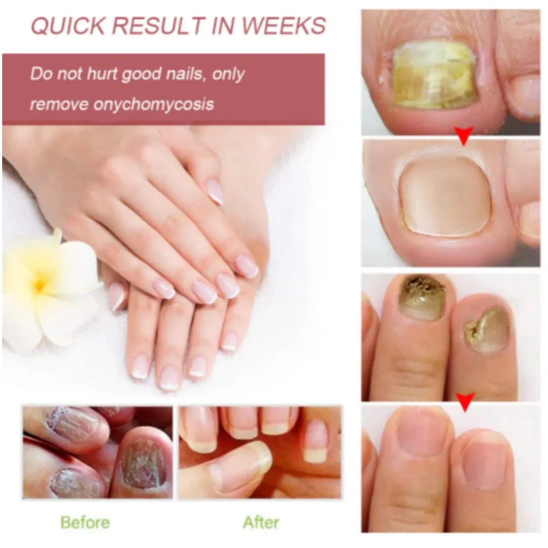 Nail serum for nail repair, fungal infection, anti-infective removal, 100% Natural Profesional 30 ML Serum For Nail Strong, Supple and Shaped Nail Care Serum (30ML PACK OF 1)