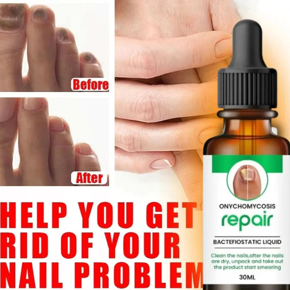 Nail serum for nail repair, fungal infection, anti-infective removal, 100% Natural Profesional 30 ML Serum For Nail Strong, Supple and Shaped Nail Care Serum (30ML PACK OF 1)