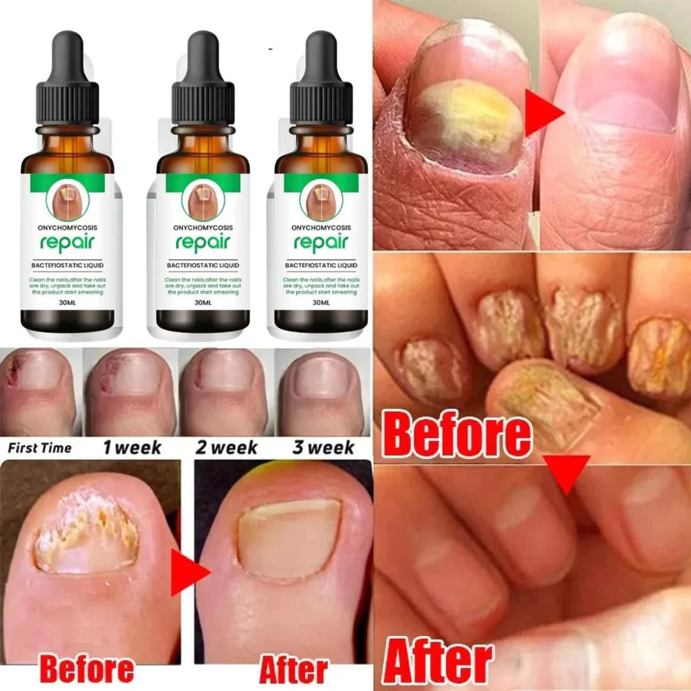 Nail serum for nail repair, fungal infection, anti-infective removal, 100% Natural Profesional 30 ML Serum For Nail Strong, Supple and Shaped Nail Care Serum (30ML PACK OF 1)