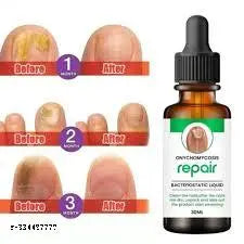 Nail serum for nail repair, fungal infection, anti-infective removal, 100% Natural Profesional 30 ML Serum For Nail Strong, Supple and Shaped Nail Care Serum (30ML PACK OF 1)