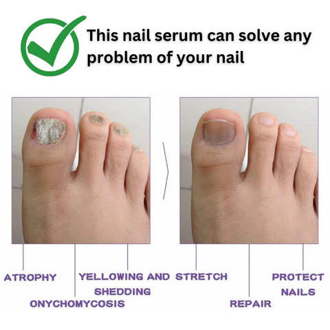 Nail serum for nail repair, fungal infection, anti-infective removal, 100% Natural Profesional 30 ML Serum For Nail Strong, Supple and Shaped Nail Care Serum (30ML PACK OF 1)
